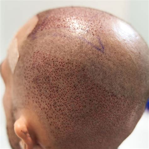 Microneedling Scalp Scars