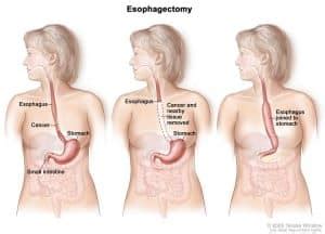 Esophagectomy - Types, Complications, Survival rate - Sutured