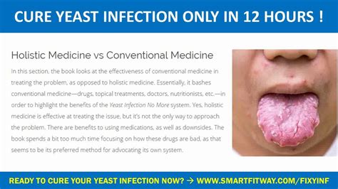 Treating Yeast Infection On Skin YouTube