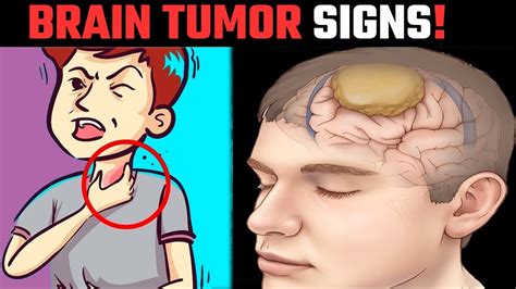 9 Warning Sign Of Brain Tumor Brain Tumor YouTube