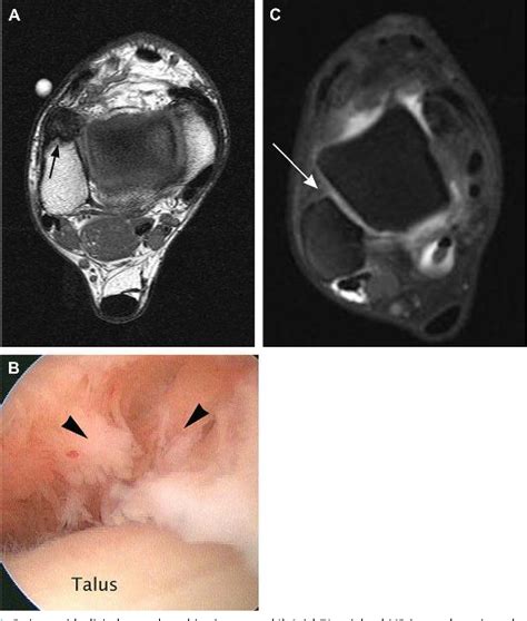 [pdf] Ankle Impingement Syndromes Semantic Scholar