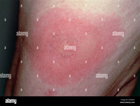 Lyme Disease Rash View Of The Thigh Of A 59 Year Old Woman Showing A Rash Caused By Lyme