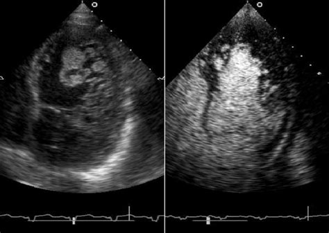 Two Dimensional Echocardiography Apical Four Chamber View With Right