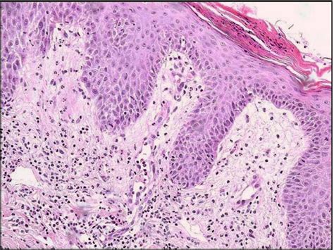 Skin Histology Demonstrating Hyperkeratosis Parakeratosis Epidermal