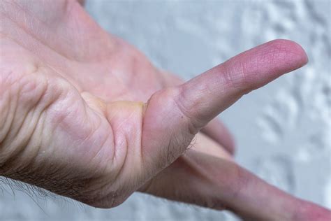 Dupuytrens Contracture Symptoms Causes Treatment