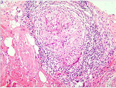 SciELO Brasil Vulvar Ulcerative Cutaneous Tuberculosis Secondary To