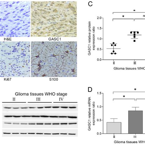 Characterization Of Gasc1 Expression In Who Stage Ii Iv Human Glioma