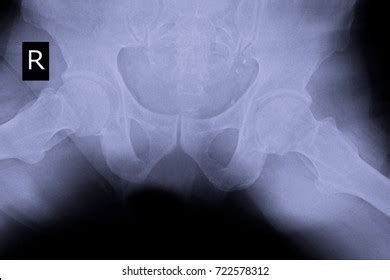 100 Femoral Head Ligaments Images, Stock Photos & Vectors | Shutterstock