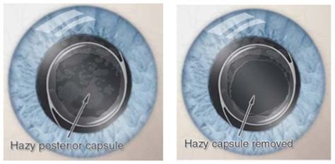 Laser Posterior Capsulotomy The Royal Victorian Eye And Ear Hospital