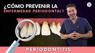 C Mo Prevenir La Periodontitis O Enfermedad De Las Enc Doovi