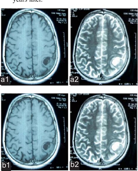 Figure From Cystic Meningiomas Report Of Four Cases Semantic Scholar