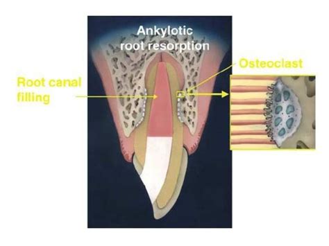 Root Resorption