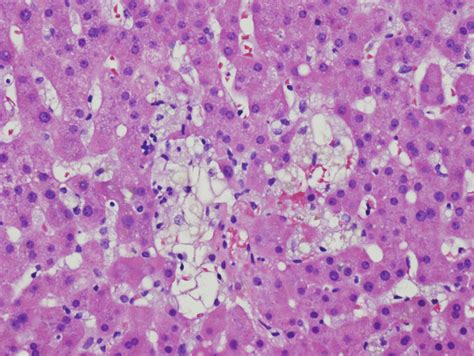 Liver Biopsy Showing Focal Hepatocyte Dropout H And E × 200 Download Scientific Diagram