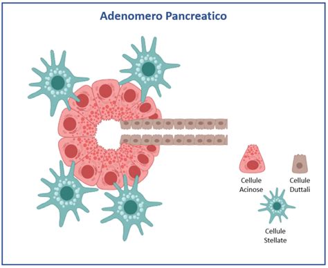 Carcinoma Del Pancreas A Cellule Acinose