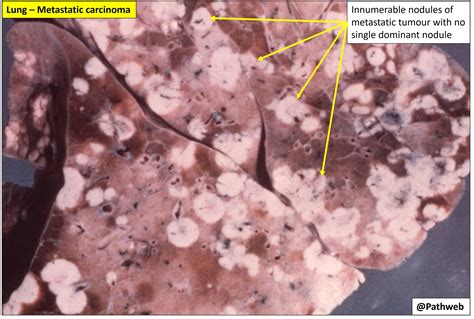 Lung Metastatic Carcinoma Nus Pathweb Nus Pathweb