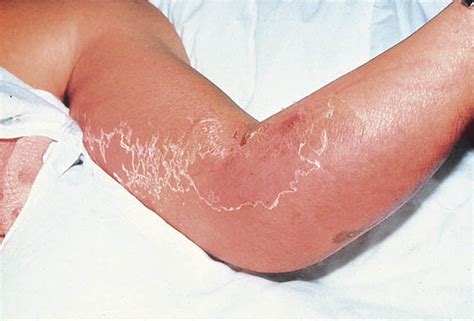 Fulminant Group A Streptococcal Necrotizing Fasciitis Clinical And Pathologic Findings In 7