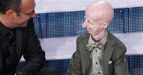 Sammy Basso che cos è la progeria che provoca l invecchiamento precoce