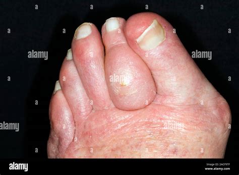 Cellulitis Swollen Toe Of An 88 Year Old Woman Caused By Cellulitis Cellulitis Is A Bacterial