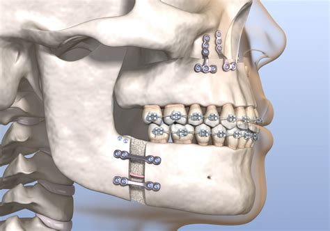 Corrective Jaw Surgery - Provincial Oral Surgery