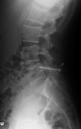 Surgical Repair of Pars Interarticularis Fractures | Colorado