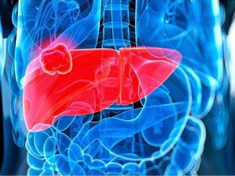 Liver Cancer Here Are The Symptoms New Therapy For Advanced Patients Time News