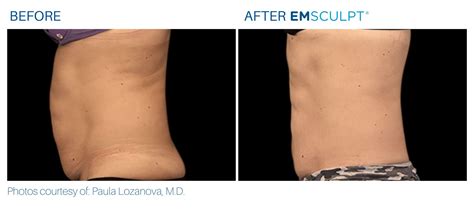 Emsculpt Before And After Real Patient Results