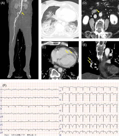 A Threedimensional Computed Tomography CT Angiography Complete