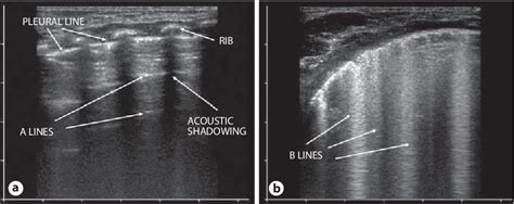 Figure 1 From Lung Ultrasound In Respiratory Distress Syndrome A Useful Tool For Early