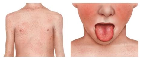 Strep A And Scarlet Fever Affinity Care