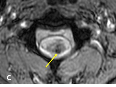 Cavernous Malformation CM Of The Spine MRI Online Is Now Medality