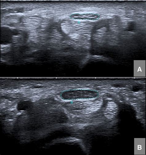 A Transverse Sonogram Of The Left Mn At The Wrist Level In A Download Scientific Diagram