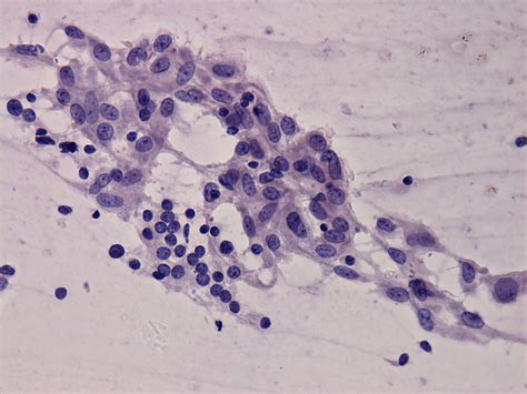 Lymphocytic Thyroiditis