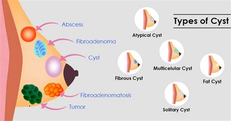 Fibroadenoma: Symptoms, Causes, Diagnosis, and More