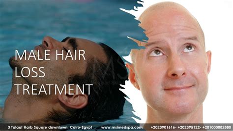 Male Hair Loss Treatment Results Before And After Youtube