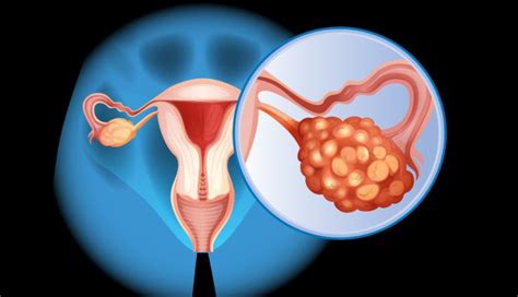 Ovarian Cancer Stages How They Are Determined Md Anderson Cancer Center