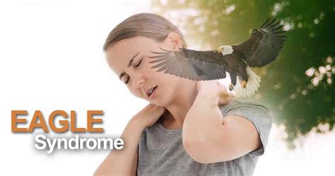 What Is Eagle Syndrome Causes Best Treatment