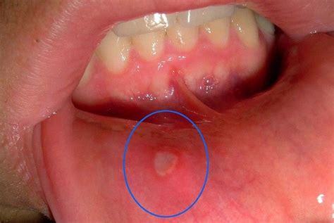 Mucocele O Que Causas Sintomas E Tratamentos Dicas De Muscula O