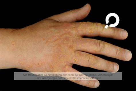 Irritativ Toxische Dermatitis Toxische Kontaktdermatitis Behandlung