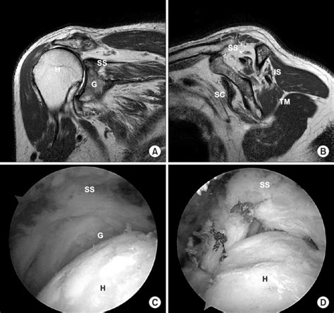 A Pre Operative Magnetic Resonance Imaging Shows A Massive Rotator