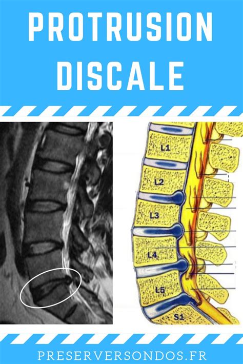 C Est Quoi Une Protrusion Discale Quelle Diff Rence Avec Une Hernie