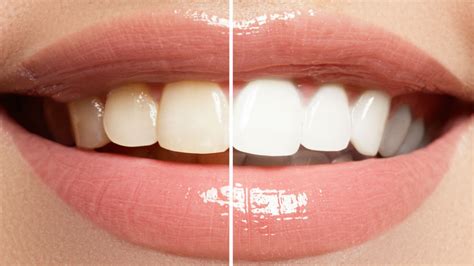 Is Teeth Whitening Safe North Sydney Dental Practice