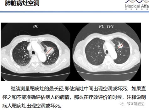 壹生资讯 实体瘤疗效评价标准全面解读！附实例！