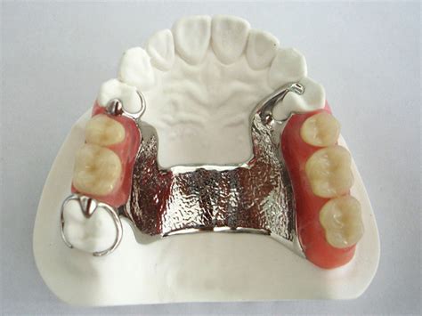 Cast partial dentures | Ralev Dental Clinic