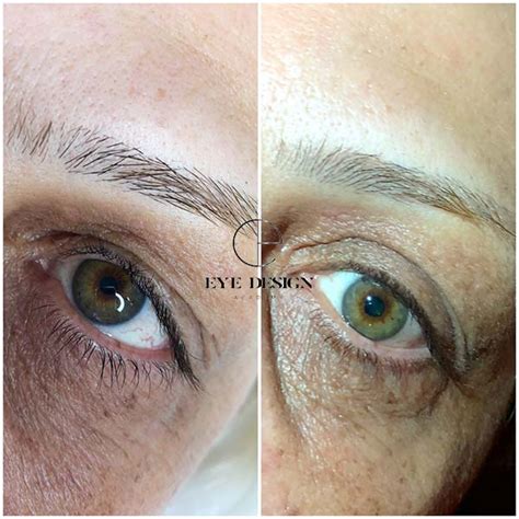 Plasma Fibroblast Before And After For Full Face Treatment