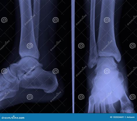 Lateral Ankle X-ray Stock Photo | CartoonDealer.com #15325728