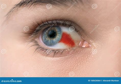 Burst blood vessel in eye stock photo. Image of eyeball - 160626064