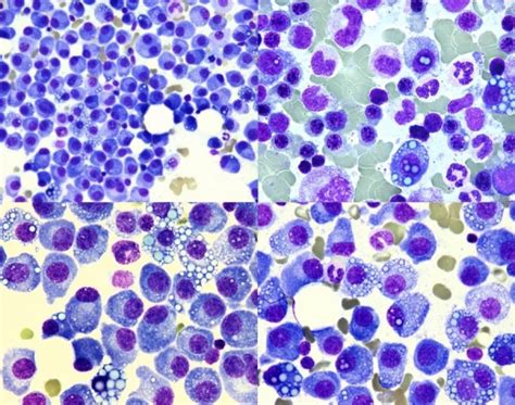 Multiple myeloma. Mott cells, Dutcher bodies and Russell bodies