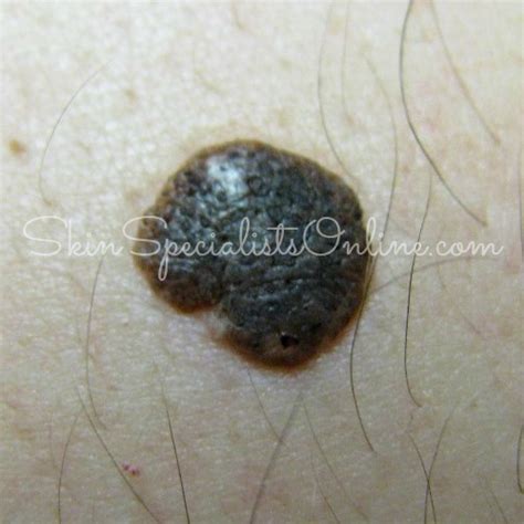 Scrotum Skin Swellings Skin Specialists Online