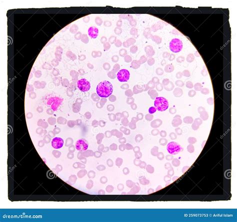 Microscopic Examination Of Blasts Or Leukemia Cells In Blood Smear Of