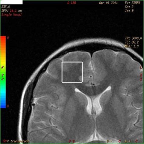 Full Article Neurochemical Metabolites In Prefrontal Cortex In